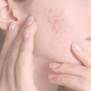 Why Gentle Skincare Works Better for Acne-Prone Skin